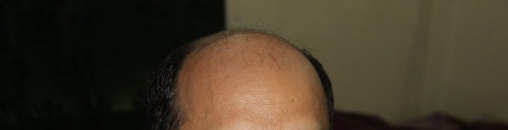 hair loss